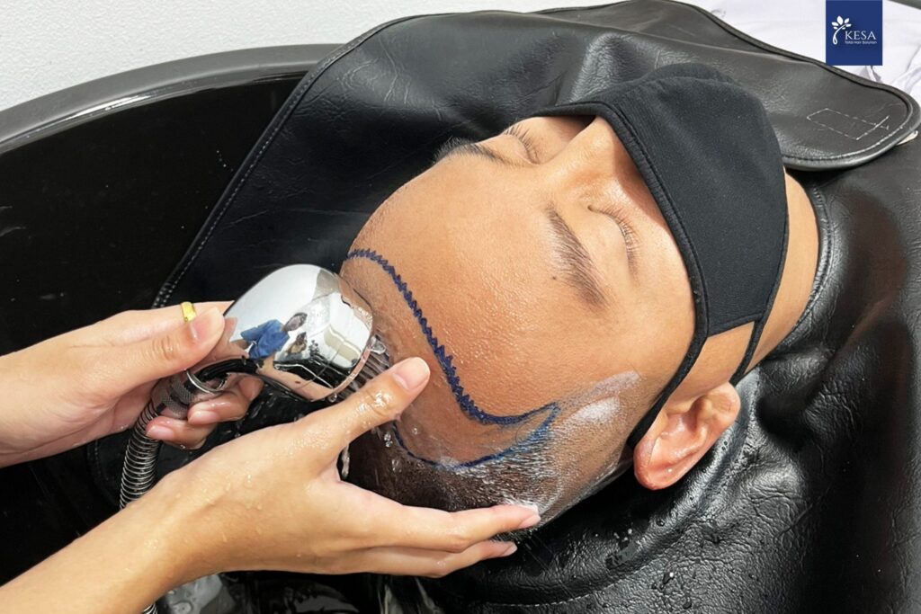 Best hair transplant clinic in bangkok