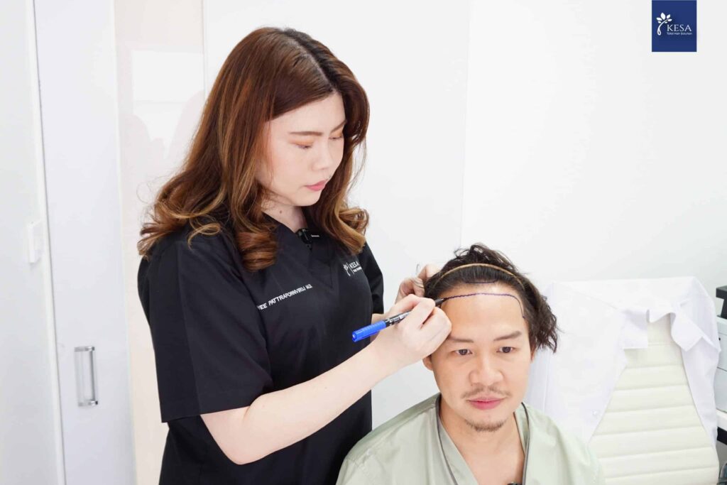 KESA Hair Transplant Before and After