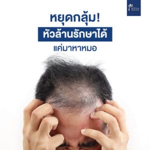 Androgenic Alopecia