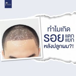 crack after hair transplant