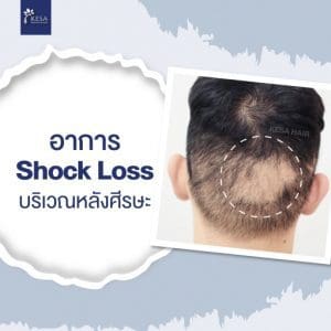 Shock loss symptoms after hair transplantation