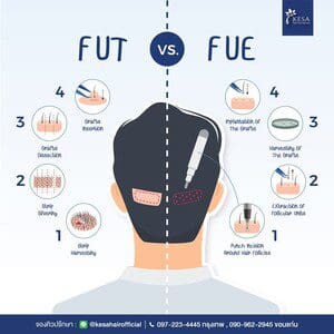 Hair transplantation