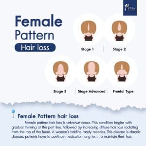 Female pattern hair loss