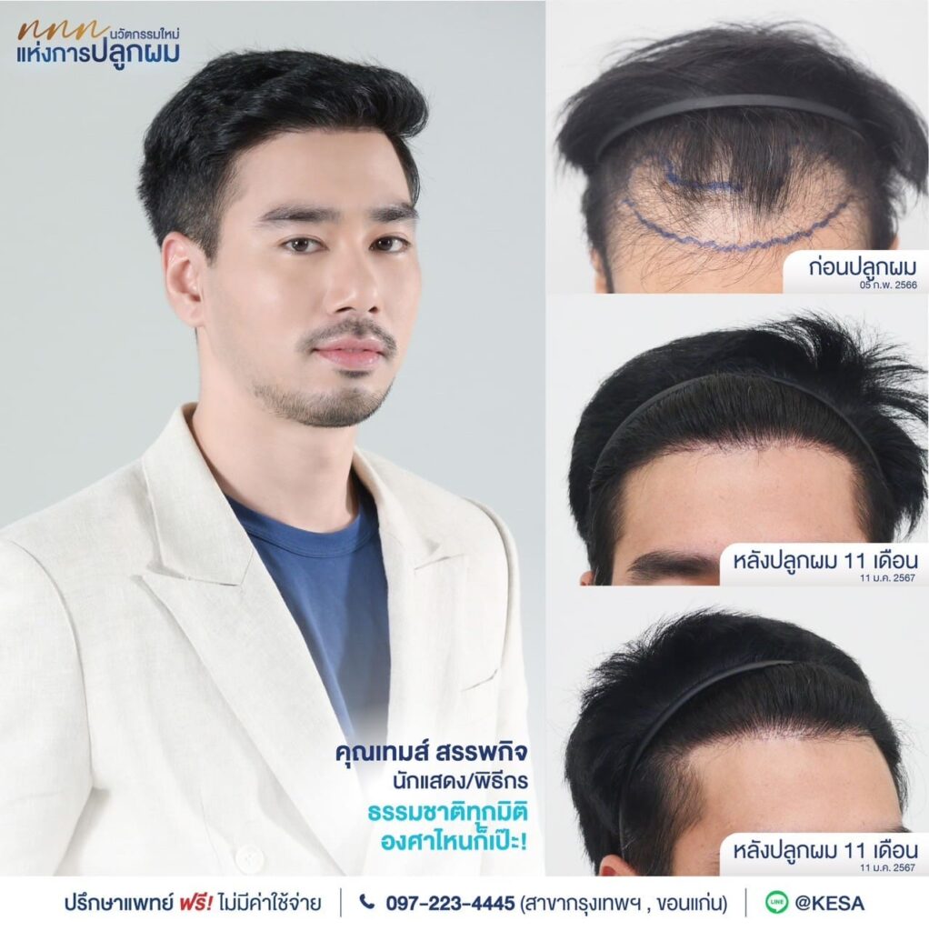 KESA Hair Treatment Before and After
