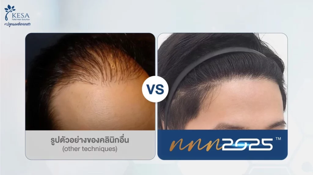 ปลูผมเทคนิค NNN