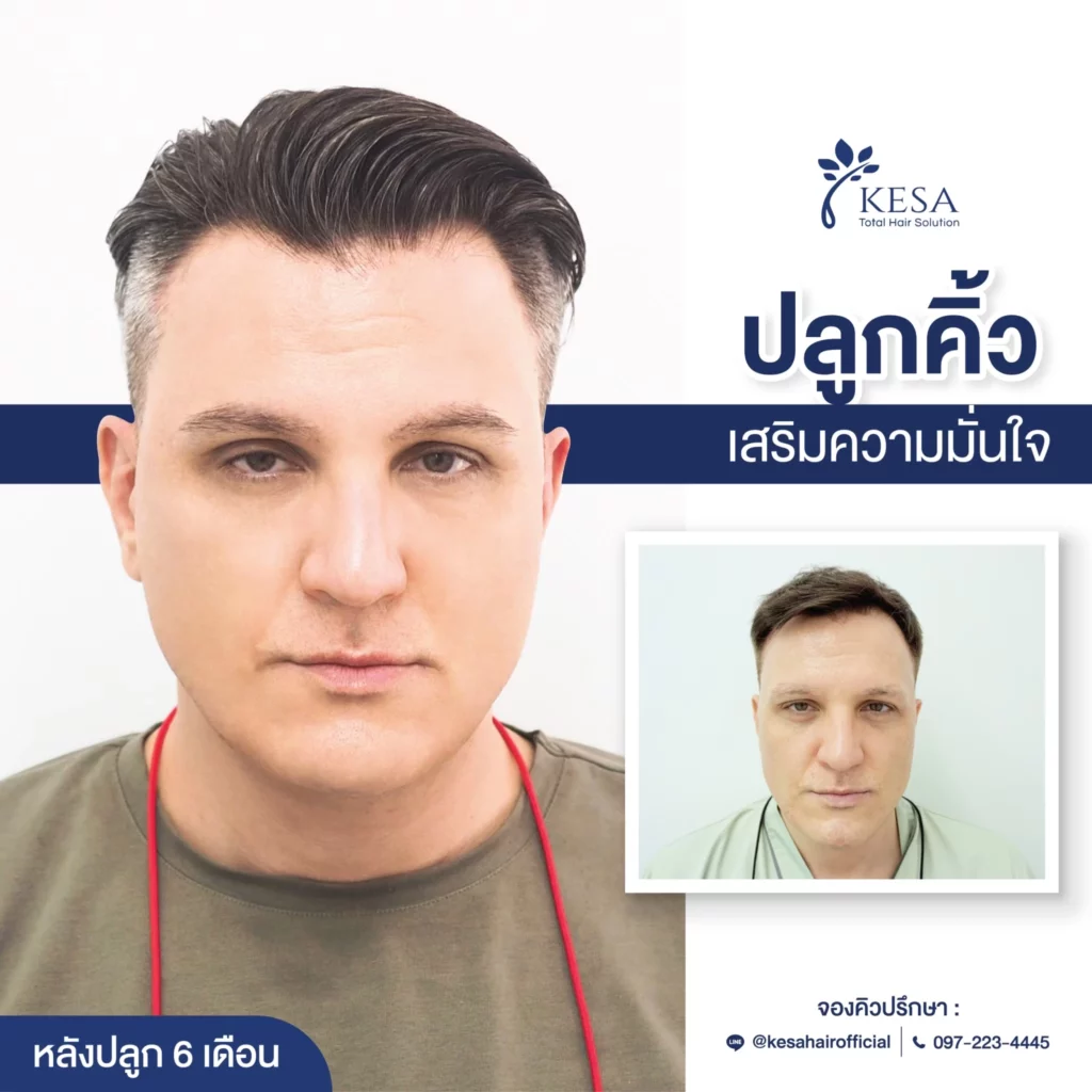 eyebrow transplantation