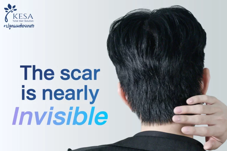 hair transplant scar