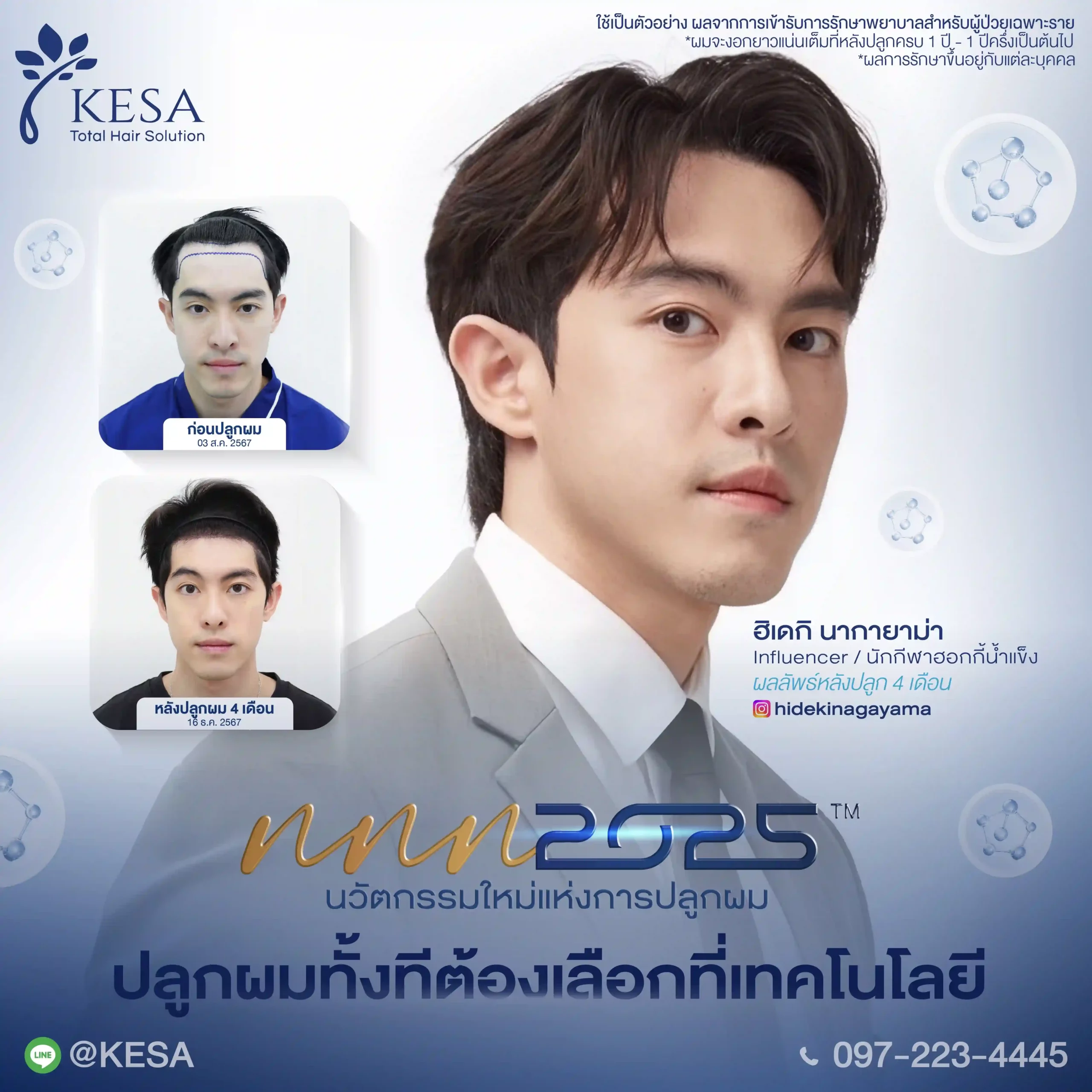 hair transplant bangkok