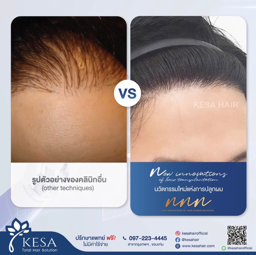 KESA NNN Hair Treatment Series Patient