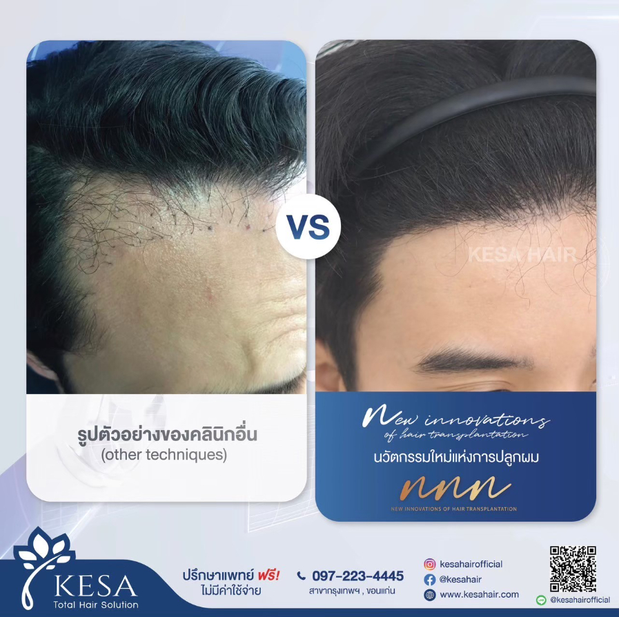 KESA NNN Hair Treatment Series Patient